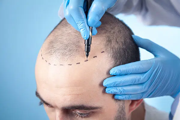 Best Hair Transplant Doctor Mclean VA